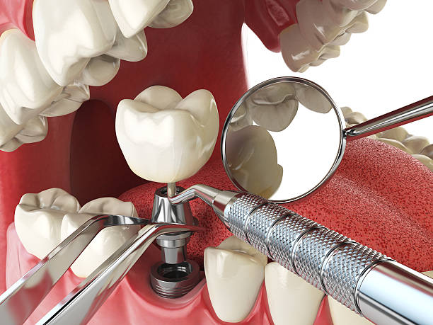 Best Emergency Root Canal Treatment in Monteagle, TN